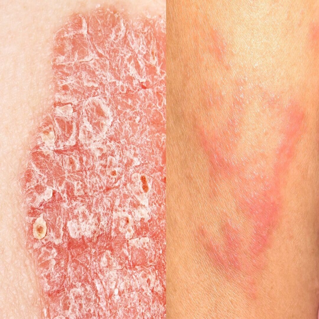 Psoriasis Eczema 
